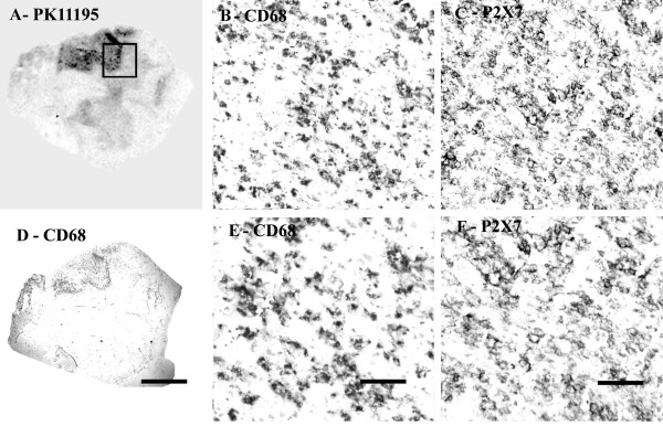 P2X7 immunoreactivity is found in microglial cells/macrophages of MS spinal cord. (A) Autoradiographic localisation of 3 [H] PK11195 in a spinal cord from a patient with MS co-located with CD68 (D) (Scale bars = 1000 μm). The square indicates the area where subsequent CD68 and P2X7 images were taken from. B) And E) Microglial cells/macrophage -like immunostaining with CD68 antibody (Scale bars = 200 μm and 100 μm respectively). C) And F) Microglial cells/macrophage -like immunostaining with P2X7 (Scale bars = 200 μm and 100 μm respectively).