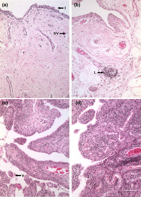 Representative haematoxylin and eosin micrographs of synovium biopsies taken at osteoarthritis or rheumatoid arthritis total knee arthroplasty. (a-c) Osteoarthritis: (a) category 1 (least inflamed), (b) category 2, and (c) category 3 (most inflamed). I, synovium intima; L, lymphoid body; SV, small vessel; V, villus. (d) Rheumatoid arthritis, category 3. Each biopsy was assigned to one of four categories: 0 = normal: synovial intima less than four cells thick, sparse cellular distribution, with few or no inflammatory cells (not shown as normal synovial fluid samples were not accompanied by synovium biopsies); 1 = mild inflammation: synovial intima three to five cells thick, slight increase in cellularity with few inflammatory cells; 2 = moderate inflammation: synovial intima four to six cells thick, dense cellularity with inflammatory cells, may exhibit as small lymphoid aggregates; 3 = severe inflammation: synovial intima five to seven or more cells thick, dense cellularity with inflammatory cells, containing many or large perivascular lymphoid aggregates. Bar = 100 μm.