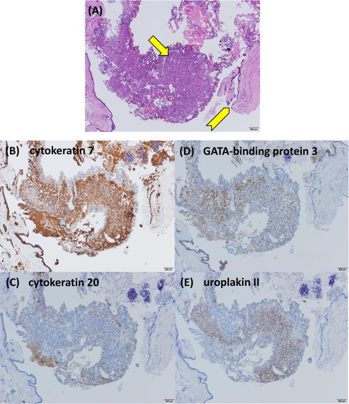 Histopathological examination of the TUR‐BT specimen revealed solid and isolated invasive proliferation (arrow) on a background of urothelium (arrowhead), with no variant histology identified (A). Immunohistochemical staining was positive for cytokeratin 7, cytokeratin 20, GATA‐binding protein 3, and uroplakin II, sequentially in that order (B–E).
