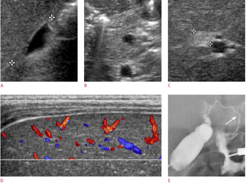 A 49-day-old boy with invisible common bile duct (CBD) on ultrasonography (US) (group B).A. Gallbladder length is 12.8 mm (crosshairs). The mucosal lining and the outer margin of the gallbladder are relatively smooth with a distinct wall. Postprandial gallbladder evaluation was not done. B. CBD is invisible in the pancreatic head portion. C. Triangular cord thickness is 5.3 mm (crosshairs), which is larger than the cut-off value of 4 mm. D. Hepatic subcapsular flow is evident on the color Doppler US. E. Operative cholangiogram shows a patent CBD (arrow) without a visible common hepatic duct, confirming type IIIa biliary atresia.