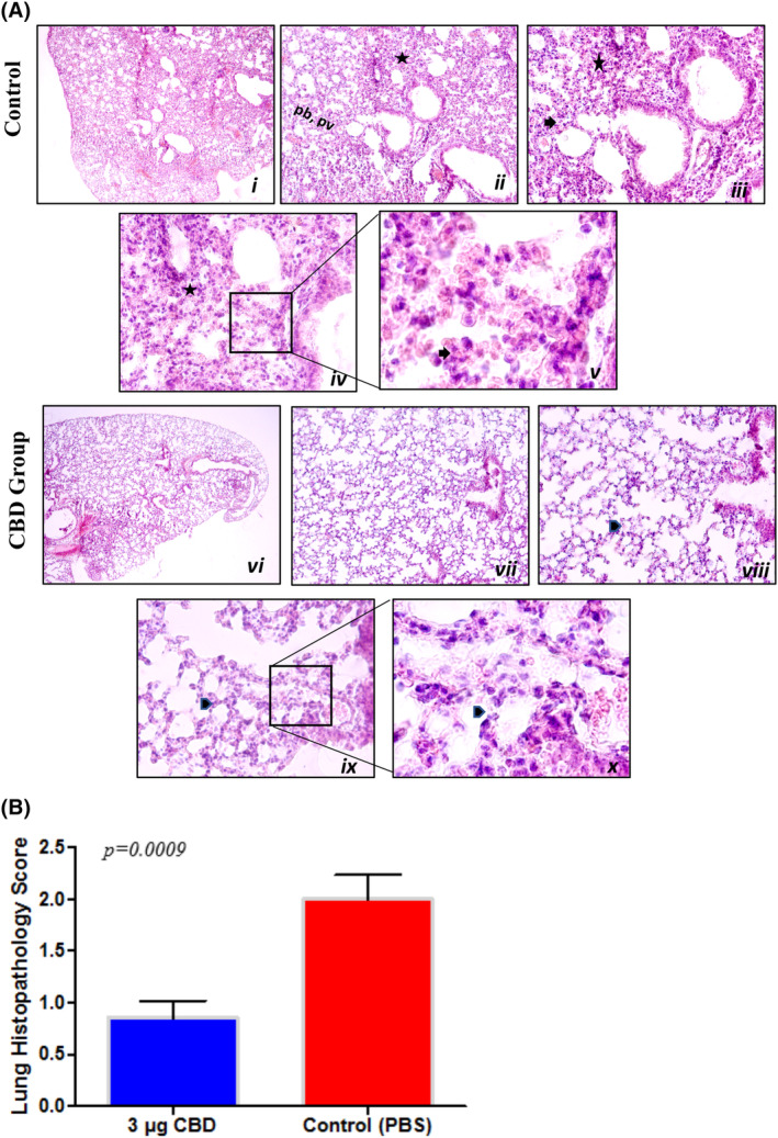 The IHC graph of all mice and several representative IHC images of lung tissue from the control (i) and cannabidiol (CBD) (ii) groups. (A) Representative IHC images of lung tissues obtained from control (i–v) and test (vi–x) groups. The tissue architecture of control group shows interstitial inflammatory cell infiltration (asterisk, ii, iii and iv), alveolar septal thickening (arrow, iii and v) and more parenchymal infiltration at peribronchiolar (pb, ii) and perivascular (pv, ii) regions. Test group shows decreased amount of interstitial inflammatory cell infiltration and normal alveolar morphology (arrowhead, viii, ix and x). Image magnification of i and vi are 4×, ii and vii are 10×, iii and viii are 20×, iv and ix are 40×, v and x are 100×. (B) Histopathology inflammation score graph of the lungs from the control and CBD group. Results for the inflammation score in the lung were significant (***p = 0.0009). A t‐test was applied for (B) statistics.