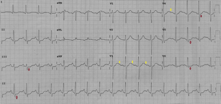 ECG showing sinus tachycardia along with wide-spread ST segment depression (red arrows) and the presence of U waves (yellow arrows).ECG: electrocardiogram