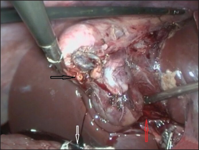 After division of cystic duct (CD) (black arrow) and artery the partially intrahepatic 2nd lobe is dissected off its fossa (red arrow). The slipped clip from gallbladder end of CD is shown by white arrow