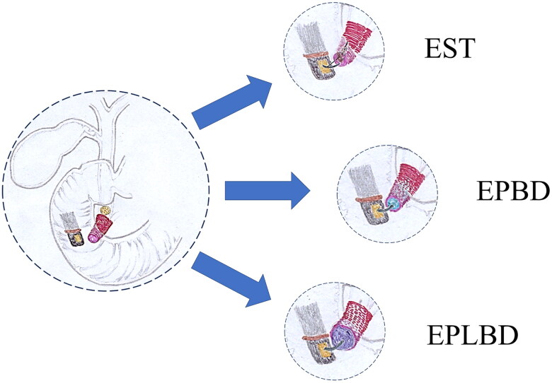 Endoscopic-assisted lithotomy resulted in different degrees of damage to the structure or function of sphincter of Oddi.Endoscopic sphincterotomy (EST) destroys the anatomical structure and function of the sphincter of Oddi (SO) by directly cutting the ampulla of Vater. Endoscopic papillary balloon dilation (EPBD) and endoscopic papillary large balloon dilation (EPLBD) tear the SO by expanding the duodenal papilla to different extents, resulting in different degrees of damage to the structure or function of the SO.