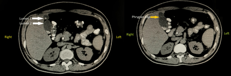 Computed tomography showing abnormal gallbladder and Phrygian capLumen 1 and Lumen 2 are highlighted by the white-coloured arrows, as the computed tomography image (left side) shows an abnormal gallbladder.The yellow-coloured arrow highlights the Phrygian cap in the given computed tomography image (right side).
