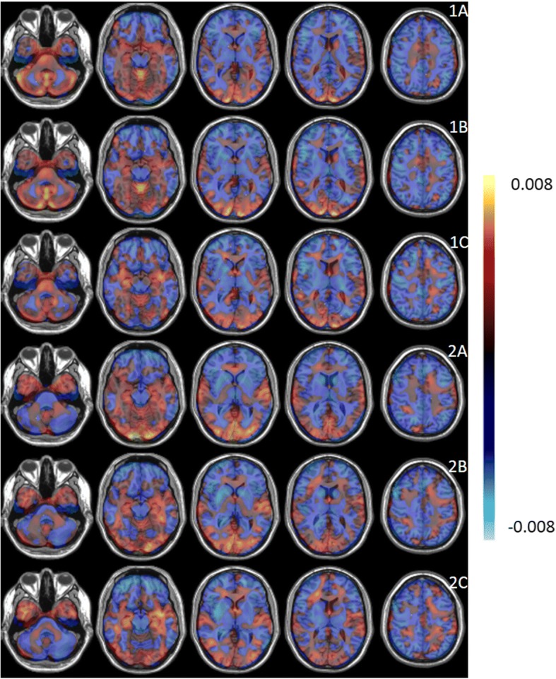 Disease-specific patterns (arbitrary units) for ALS (1) and PP (2) determined by PCA-LR (a), PCA-SVM (b), and SVM (c). The values in each voxel represent the weights of the contribution of the voxel for the classifier. Positive values (red) indicate regions of hypermetabolism of ALS or PP patients compared to HC whereas negative values (blue) correspond to hypometabolism of ALS or PP patients compared to HC