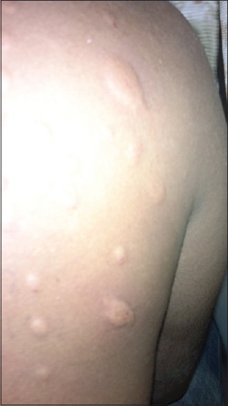 Large size and pseudopodia suggestive of 3+ reaction at the top right corner in skin intradermal test
