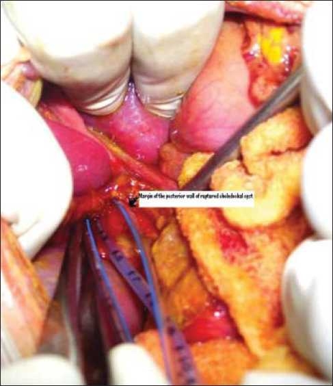 Intraoperative photograph showing ruptured choledochal cyst with a feeding tube inside upper end of common bile duct