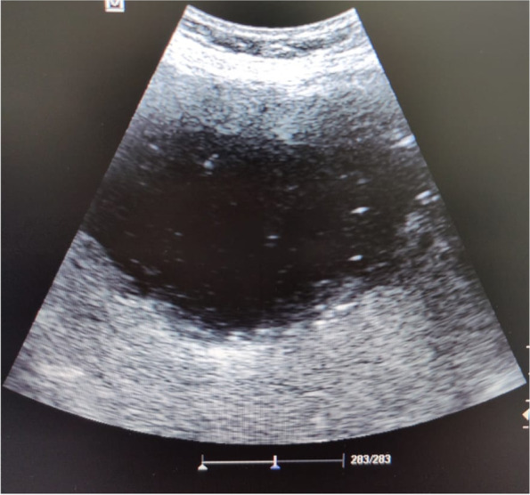 Ultrasonographic picture of the right liver lobe delineating cystic like structure with fine reticulations
