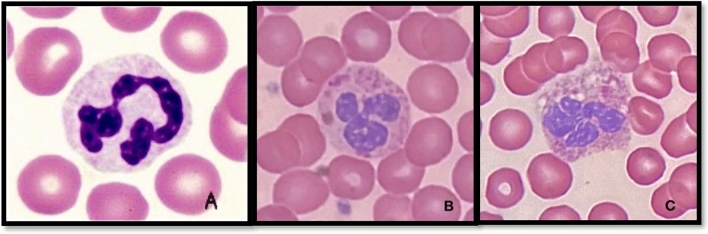 The microscopic view of blood film for patients who abuse the mixing drugs “Amphetamine and Cannabis”. (A) Normal neutrophils. (B–C) Neutrophils with toxic change.