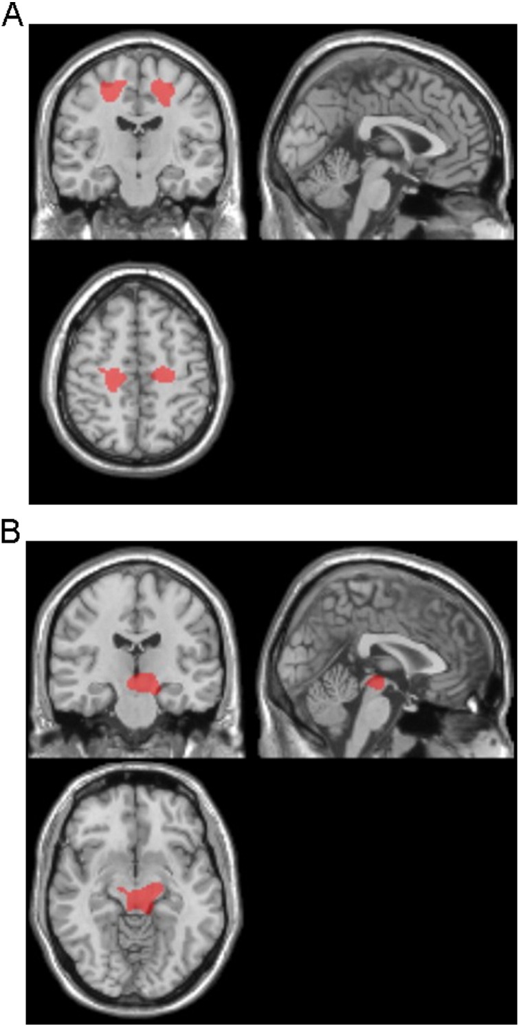 Target VOIs for CBS- and RS-specific atrophy.The target VOIs of CBS- (A) and RS- (B) specific atrophy are determined from the results of VBM analyses, which reveal the significant bilateral frontal subcortical WM atrophy in CBS patients, and the significant midbrain atrophy in RS patients.