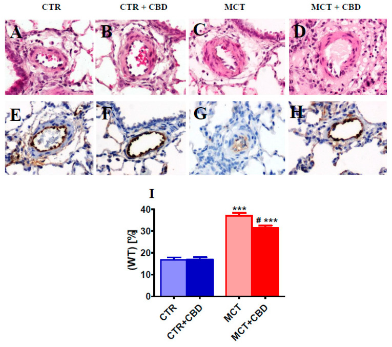 The effect of chronic administration of cannabidiol (CBD) on pulmonary vascular remodeling (A–D,I) and von Willebrand factor immunoreactivity (E–H) in the rat pulmonary small arteries. Representative images of occluded vessels (only found in MCT-induced pulmonary hypertension (G)) and percentage of medial wall thickness (WT.%) (I) are presented as mean ± SEM in n = 8 per group. CBD 10 mg/kg or its vehicle was injected intraperitoneally every 24 h for 21 days. Representative photomicrographs magnification 200×. CTR—control, MCT—monocrotaline. # p < 0.05, *** p < 0.001 compared to the respective control groups (* CTR or # MCT).