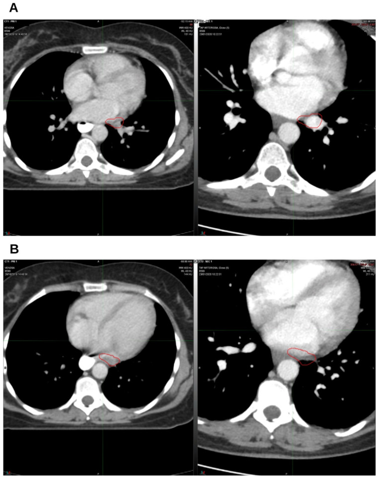 The first follow-up at 3 months off. On the left, CT from October 2019, pre-radiation therapy treatment; on the right, CT from January 2020. (A) Hilar lymph node; (B) left para-aortic lymph node. The indicated region highlights the boundary of the treated target.