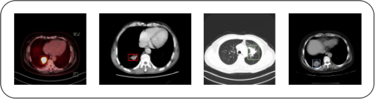CT scan images show lung nodules with different locations and shapes.
