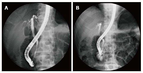 Endoscopic retrograde cholangiopancreatography pictures of successful endoscopic stenting in a male patient with a short stricture (19.3 mm). A: Before stent therapy; B: After 1 year of stent therapy.