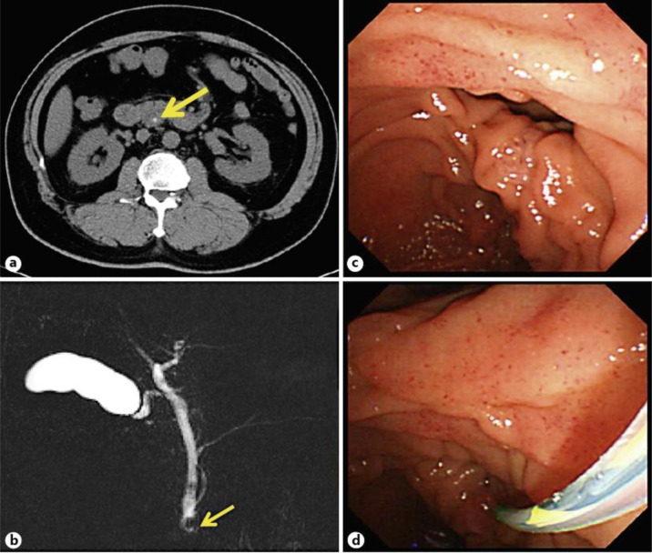 Various imaging findings. a Abdominal computed tomography scan revealed that there was a CBD stone (arrow) and no findings suggestive of cholecystitis. b MRCP revealed a defect suggesting a CBD stone (arrow) and narrowing of the CBD (diameter 5 mm). c ERCP revealed that there was a peripapillary duodenal diverticulum. d The peripapillary duodenal diverticulum made it impossible to insert the cannulation tube into the CBD.
