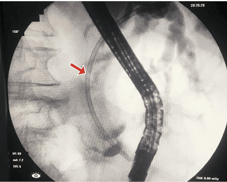 Cholangiogram taken during ERCP showing plastic stent inside CBDThe red arrow shows the plastic stent placement inside CBD.ERCP, endoscopic retrograde cholangiopancreatography; CBD, common bile duct