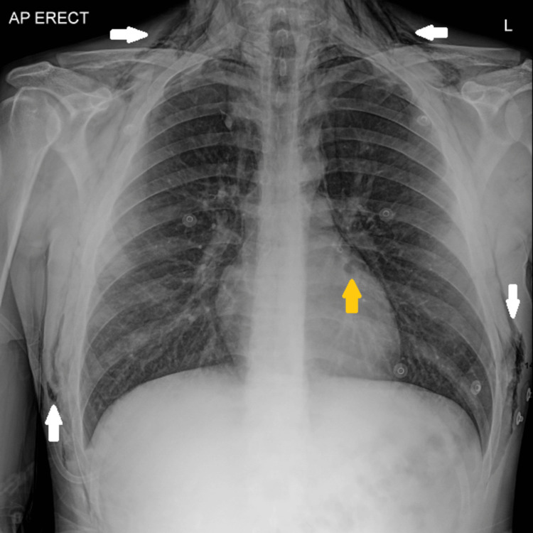 X-ray of the chest demonstrating extensive surgical emphysema (white arrows) in the chest wall and subcutaneous tissues, extending up to the neck on both sides, and associated pneumomediastinum (yellow arrow).