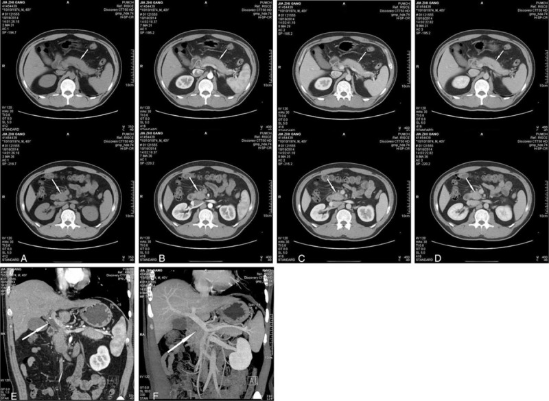 Pancreatic protocol with CT + 3D reconstruction demonstrates an uncinate mass of the pancreas and the swollen in the body and tail of the pancreas. (A) to (D) represent the plain phase, arterial phase, portal phase, and venous phase, respectively. (E) shows the dilated common bile duct, and (F) reveals the anatomical relationship of the uncinate process and the superior mesenteric vein.