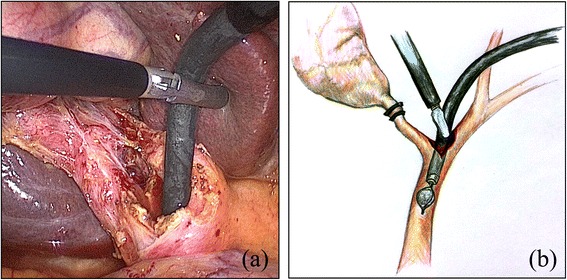 Confirmation of CBD clearance using the choledochoscope through a V-shaped incision. (a) Operative view; (b) Illustration
