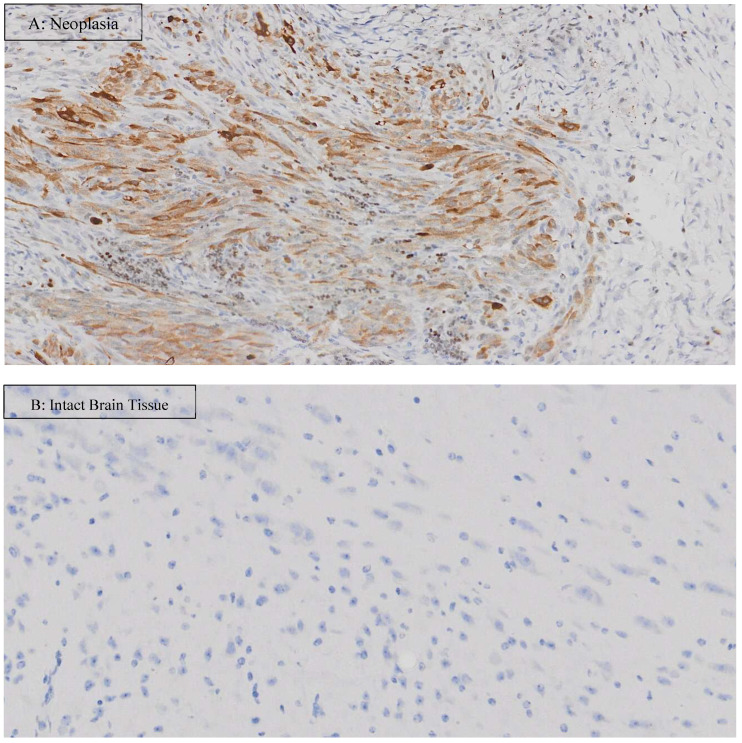 Ki-67 staining of J3TBG glioma in mice brain. The picture on the top (A) shows neoplasia, and the picture on the bottom (B) shows intact brain tissue in the CBD group (magnification ×20). Ki-67-positive cells that are stained brown are illustrated in the top picture (the neoplasia) but not in the bottom picture (the intact brain tissue).