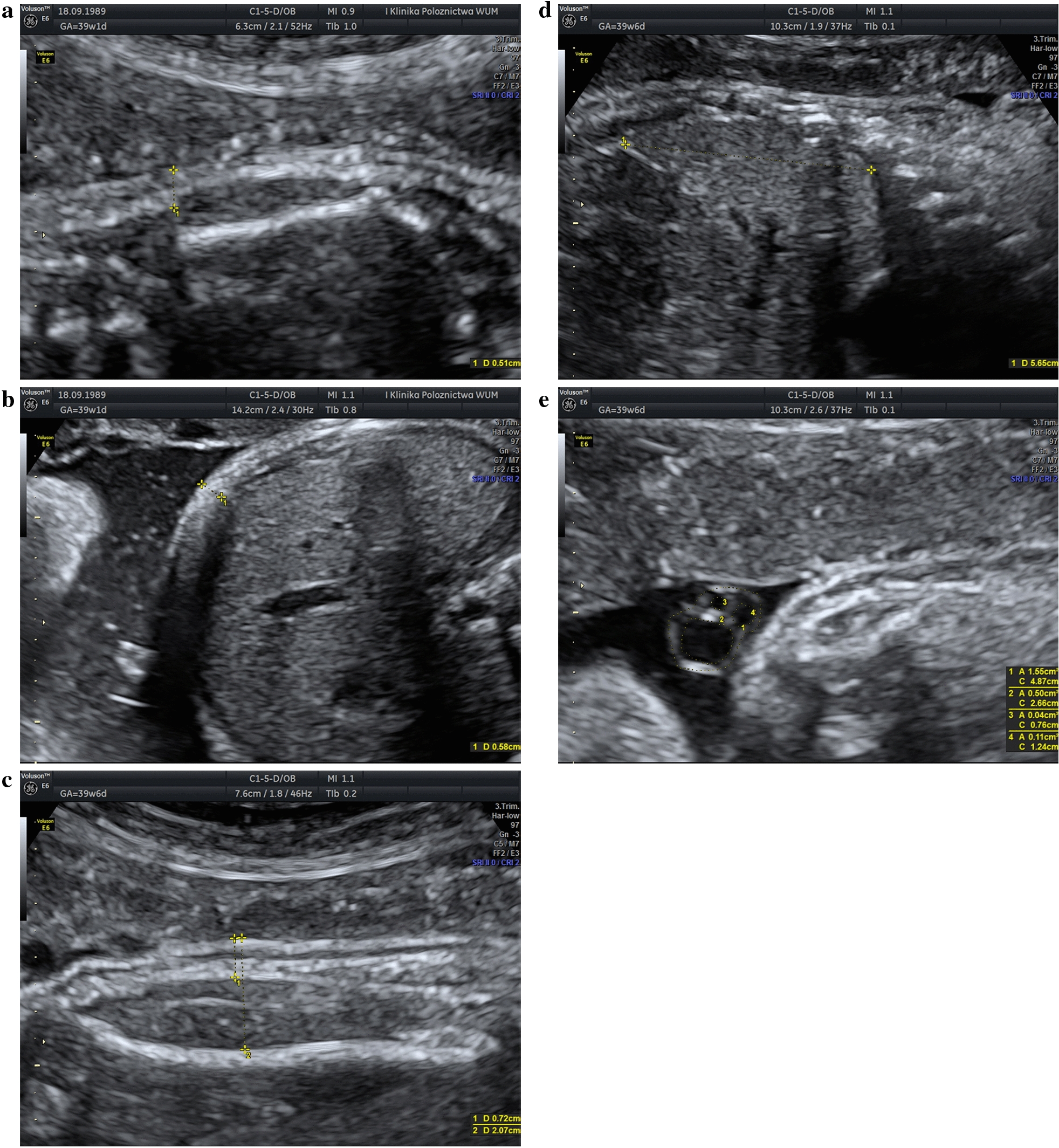 Ultrasound images presenting fetal sub-scapular fat mass (a), abdominal fat mass (b), mid-thigh fat mass/mid-thigh lean mass (c), liver length (d), umbilical cord/umbilical vein/umbilical artery circumference and area (e) measurement technique