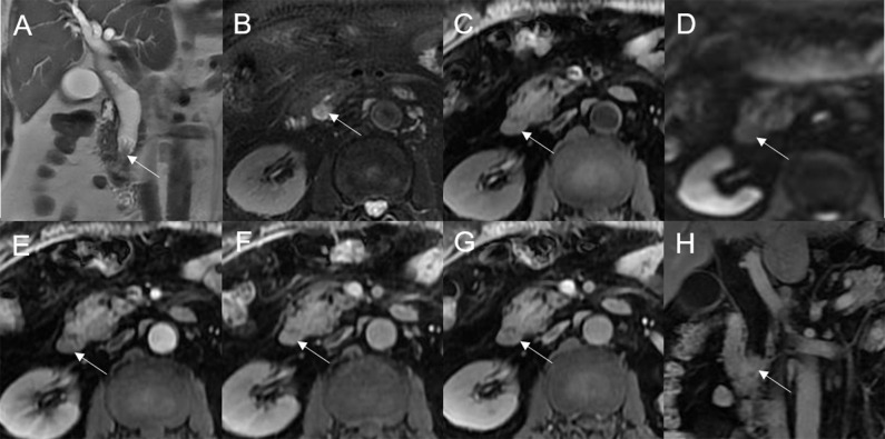 Adenoma in the distal common bile duct. The bile duct casting mass with a frond-like superficial appearance (white arrow) shows hyperintensity on T2WI (A, B), isointensity on T1WI (C), and hyperintensity on DWI (D). There is narrowing of the bile duct lumen at the lesion site and dilation of the duct upstream of the lesion (A). The T1-postcontrast arterial phase (E) shows slight enhancement. The T1-postcontrast portal phase (F) and T1-postcontrast delayed phase (G, H) show moderate enhancement.