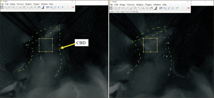 The ICG angiography images were analyzed at 10-second intervals using the Image J software program. The fluorescence intensity was measured in a 1 × 1 cm area (square), positioned as close as possible to the recipient`s CBD (dotted line) proximal margin. ICG, indocyanine green; CBD, common bile duct.