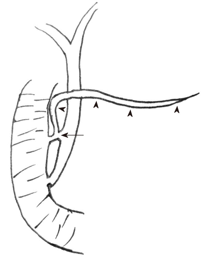 Schematic representation of the pancreaticobiliary system. This child had three anomalies: Pancreaticobiliary maljunction, pancreas divisum (arrowheads indicating dorsal pancreatic duct), and abnormal communication between the common bile duct and dorsal pancreatic duct (arrow).