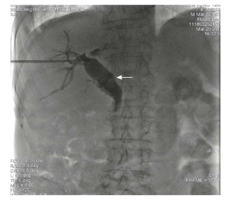 Ursodeoxycholic acid was given and repeated cholangiography was performed. The secondary common bile duct stones originating from the gallbladder (white arrow) and shrunk gallbladder were detected by cholangiography.