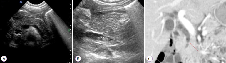 Abdominal radiologic studies show the dilated intrahepatic and common bile duct (CBD) with 0.94 cm in diameter (A), and a 4.7-mm-sized echogenic material in the distal CBD (B) on abdominal ultrasonography. Pancreaticobiliary computed tomography reveals a web-like structure (arrow) in the CBD (C).