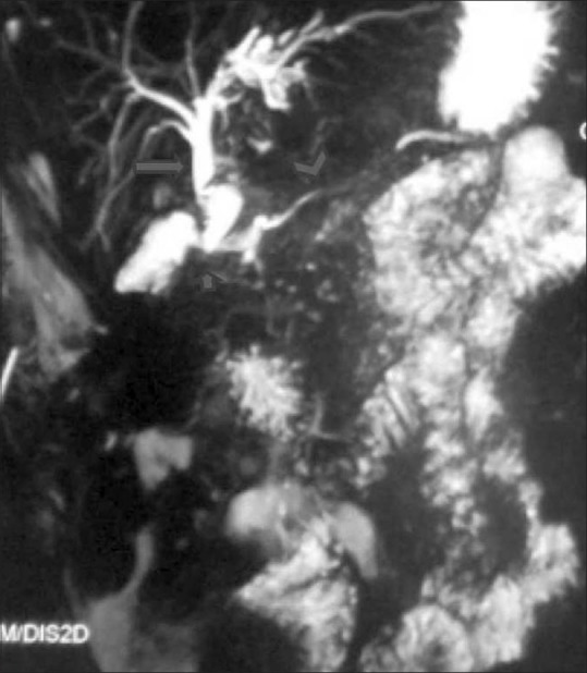 Thick slab magnetic resonance cholangiopancreatography (MRCP) image reveals mild dilatation of the entire common bile duct (CBD, arrow) with smooth distal tapering (short arrow). No filling defects are seen within the CBD The main pancreatic duct is of normal calibre (arrowhead)