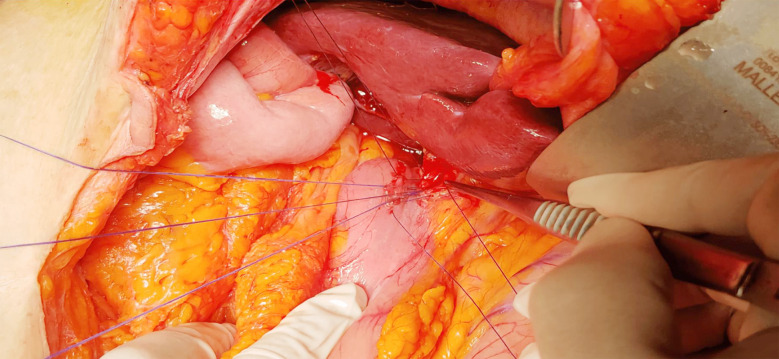 Diamond shaped side-to-side choledochoduodenostomy anastomosis.