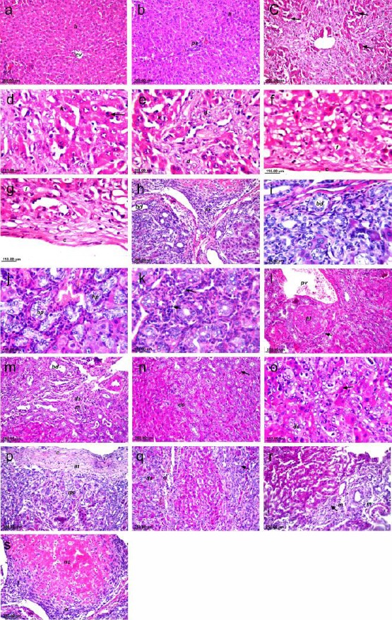 AM1241 treatment (3 mg/kg for 3 weeks) alleviated histopathological deterioration using H&E staining (×40 & ×80) in hepatic fibrosis associated with bile duct ligation (BDL). Liver sections of (a & b) sham rats showing the normal histological structure of the central vein (cv), surrounding hepatocytes (h) in the parenchyma, and normal portal area (pa). (c, d & e) BDL liver tissue is showing coagulative necrosis (arrow) with deeply eosinophilic cytoplasm and pyknotic nuclei hepatocytes while other dysplastic (d) with disfiguration and cytomegaly and karyomegalocytic cells (k). (f & g) BDL liver tissue is showing thick capsule (c) with fatty changes (f) in underlying hepatocytes. (h & i) BDL liver tissue is showing massive inflammatory cell infiltration (m) in the portal area with hyperplastic bile duct cells resembling hepatocytes, biliary epithelium and extending to the parenchyma (bd). (j) BDL liver tissue is showing hyperplasia and hypertrophy (hp) with ductular glandular structure presented in freshly damage liver cells as a regenerative effect (neocholangiolar proliferation). (k) BDL liver tissue is showing oval or spindle cell (arrow) basophilic extended in between the hyperplastic hypertrophic bile ducts in the hepatic parenchyma. (l) silymarin treated liver tissue showing dilated portal vein (pv) with lobulation of the hepatocytes (hl) with multiple proliferated oval or spindle cells (arrow) and dysplasia (ds) in the other with prominent nucleoli. (m) silymarin treated liver tissue showing increase proliferation of the bile ducts (bd), hypertrophic biliary epithelium, atypia and inflammatory cell infiltrate (m) in portal area. (n & o) silymarin treated liver tissue showing coagulative necrosis in some of the hepatocytes, dysplasia in other with enlarged spindle cells extended in between in the parenchyma. (p) AM1241 treated liver tissue showing thickening (c) with inflammatory cells infiltration (m) in the hepatic capsule with dysplasia (ds) in the underlying hepatocytes and atrophy in other. (q) AM1241 treated liver tissue showing oval cells proliferation (o) in between the dysplastic hepatocytes (arrow). (r) AM1241 treated liver tissue showing inflammatory cells infiltration (m) with few fibroblastic cells proliferation in the portal area (arrow). (s) AM1241 treated liver tissue showing focal loss of cell detail and architecture as necrosis (ne) surrounded by fibrosis (f) and oval cells (o)
