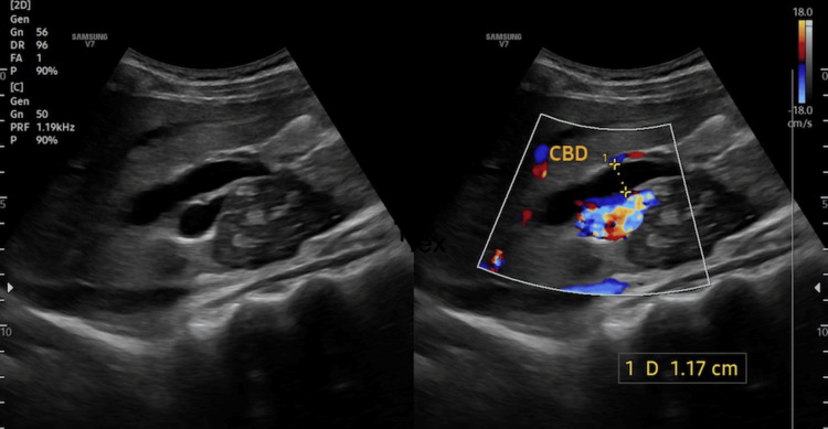 Transabdominal ultrasonography of the hepatobiliary systemUSG demonstrates dilatation of the common bile duct (CBD), measuring approximately 1.17 cm in diameter. The duct appears prominently dilated with evidence of upstream biliary dilatation. Color Doppler imaging shows no significant internal vascularity within the duct, supporting a non-vascular obstructive etiology.