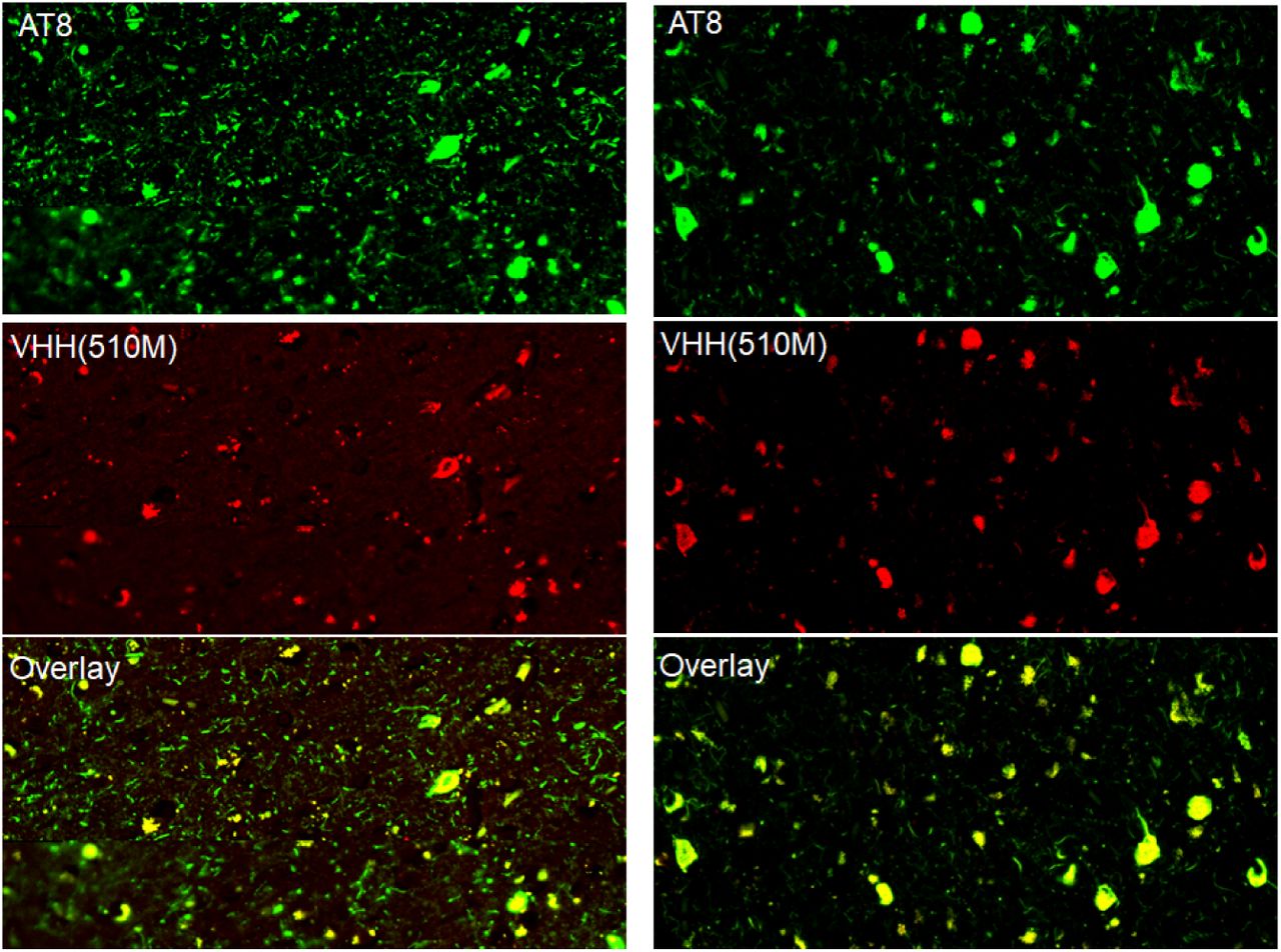 VHH(510M) immunoreactivity in human AD brain tissue.Representative images from tissue microarray sections of fixed frontal cortex of an AD case. Staining with the phospho-tau antibody AT8 (green) and anti-tau VHH(510M) (red) reveals co-localization of tau inclusions in overlapping regions (yellow in overlay). These findings support the selectivity of VHH(510M) for disease-relevant tau aggregates in human AD brains.
