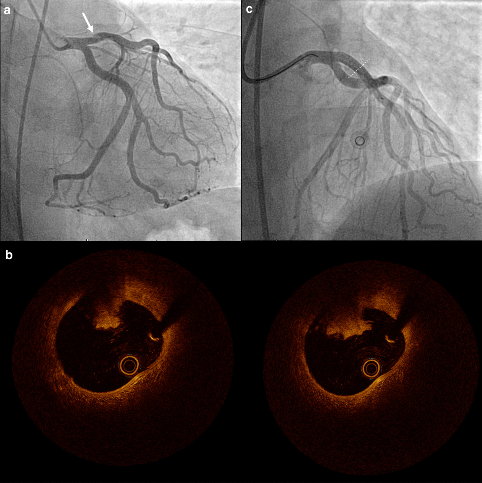 Angiography and OCT findings. a Thrombotic lesion in the proximal LAD, b adhesive non-occlusive predominantly white thrombi superimposed on a fibrous plaque in 2 consecutive OCT frames, c final angiographic result after stenting. LAD = left anterior descending artery, OCT = optical coherence tomography