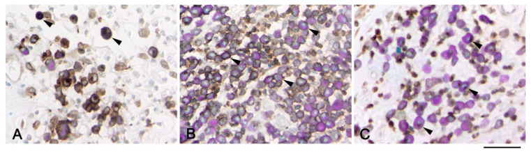 Association between toluidine blue stain and immunohistochemistry of c-kit. Canine mast cell tumors showing cytoplasmic (A, arrows), membranous (B, arrows), and Golgi-like (C, arrows) expression of c-kit. Metachromatic red stain in the cytoplasm is present in (B) (membranous) and (C) focal cytoplasmic type of expression, while it is hidden in (A) when a cytoplasmic diffuse immunohistochemical stain is present. Scale bar = 50 µm.