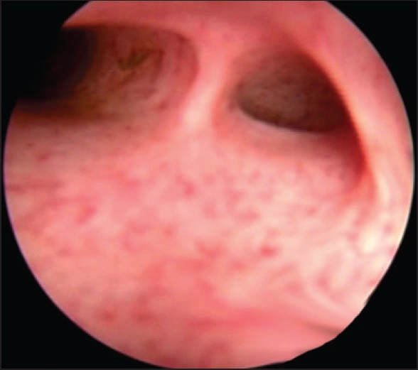 Both right and left hepatic duct interiors are visible