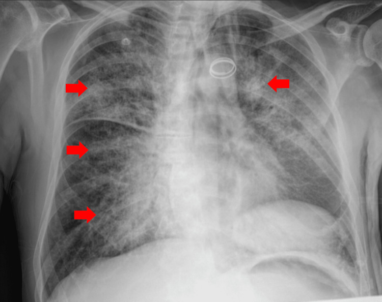 Chest X-ray showing a diffuse bilateral reticulonodular pattern (red arrows), consistent with the patient’s presentation of acute respiratory distress syndrome (ARDS).