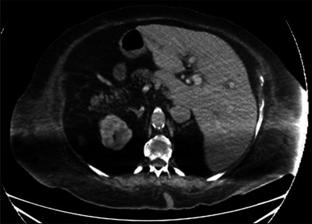 Axial computed tomography scan post endoscopic retrograde cholangiopancreatography demonstrates resolution of the dilated biliary system.