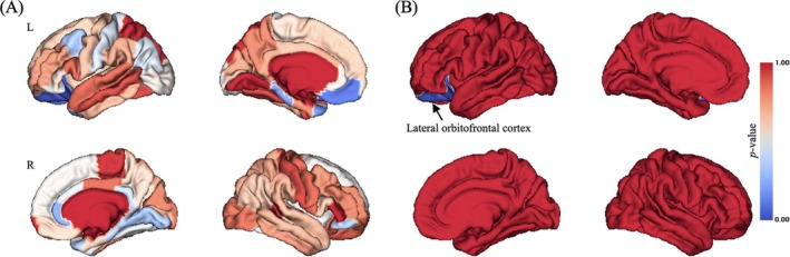 Brain pattern of group‐by‐time point interaction effect on CT. (A) Uncorrected p value distribution for group‐by‐time point interaction effect on CT; (B) Bonferroni correction of p value distribution for group‐by‐time point interaction effect on CT. L, left; R, right. The colour bar represented p value of group‐by‐time point interaction effect on CT.