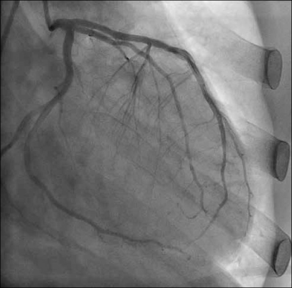 Angiographies demonstrating LMCA, LAD, and Cx in the right anterior oblique position