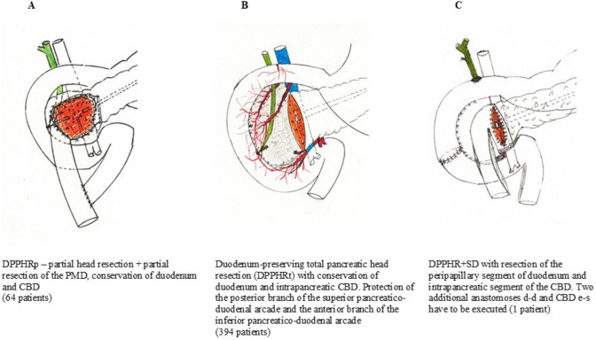 A DPPHRp—partial head resection; partial resection of the PMD, conservation of duodenum and CBD (64 patients) B duodenum-preserving total pancreatic head resection (L-DPPHRt) with conservation of duodenum and intrapancreatic CBD. Protection of the posterior branch of the superior pancreaticoduodenal arcade and the anterior branch of the inferior pancreaticoduodenal arcade (394 patients). C DPPHR + SD with resection of the peripapillary segment of duodenum and intrapancreatic segment of the CBD. Two additional anastomoses duodenum d-d and CBD e-s have to be executed (1 patient)