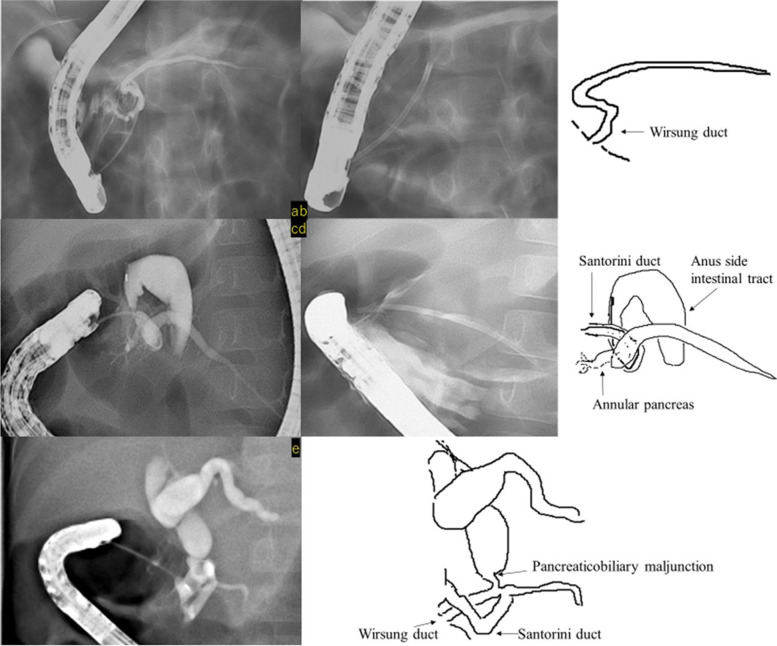 a, b: Case 2 - Pancreatic duct stent insertion into the caudal pancreatic duct from the main papilla for flexion of the Wirsung duct (c, d): Case 3 - Contrast-enhanced imaging of the accessory papilla: insertion of a pancreatic duct stent into the caudal pancreatic duct (e): Case 4 - Contrast-enhanced imaging of the accessory papilla: angulation of the Santorini duct, and pancreaticobiliary maljunction and choledochal duct dilatation were observed