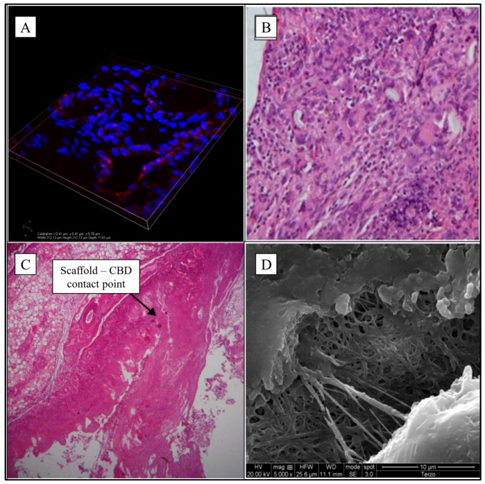 Microphotographs of implanted scaffolds. (A) 3D organization of endothelial cells with confocal microscope (Nikon a1—width 212.13 µm, height 212.13 µm, depth 11.63 µm—cellular nucleus in blue, antibodies anti-CD31 in red); (B) Gallbladder-jejunal scaffold histological examination (EE20×) shows intense chronic inflammatory infiltration in the portion of the scaffold; (C) CBD tubular scaffold histological examination shows the contact point of proximal anastomosis (EE5×); (D) the scaffold patch of CBD is partially degraded at electron microscopy 5000×. Sources: (A,C,D) are reprinted from Ref. [38]; (B) = owned by the co-authors.
