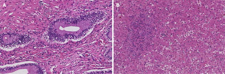 Pathological results of biliary tract tissue and liver tissue. A: Hematoxylin and eosin (HE) staining of bile duct (× 10), it is consistent with a choledochal cyst, with congestion in the cyst wall and scattered chronic inflammatory cell infiltration; B: HE staining of liver tissue (× 10), liver tissue pathology shows loose and light staining of the cytoplasm, mild to moderate inflammation in the lobules, moderate inflammation in the portal area, more acute and chronic inflammatory cell infiltration, and some sinks. Hyperplasia of small bile ducts and fibrous tissue in duct area.