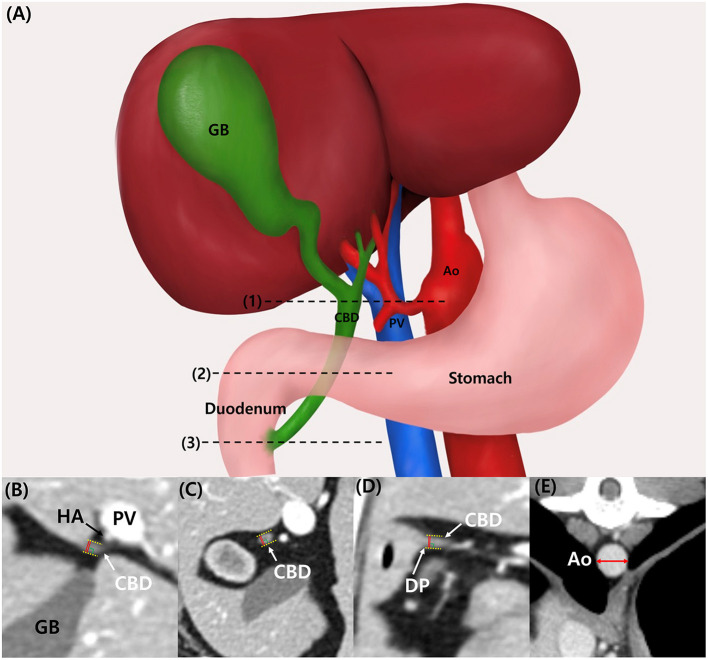 Illustration of common bile duct in dogs. (A) The location of measurement of common bile duct diameter (CBD) were as following: porta hepatis (PH) level (1), duodenal papilla (DP) level (3), and mid-portion (Mid) between these points (2). CT images of CBD at PH level (B), Mid-level (C), and DP level (D). The measurement of CBD is made including the ductal wall (yellow dotted line), and the widest diameter was measured (red line) perpendicular to its long axis. CT images of aortic diameter (Ao) measurement (E). For the Ao measurement, minor axis diameter (red double arrow) was measured. Ao, aorta; CBD, common bile duct; CT, computed tomography; DP, duodenal papilla; GB, gallbladder; HA, hepatic artery, Mid, mid-portion; PH, porta hepatis; PV, portal vein.