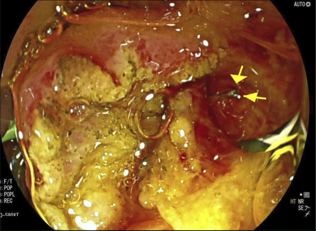 Endoscopic retrograde cholangiopancreatography image showing a sharp foreign body emerging from the bile duct.