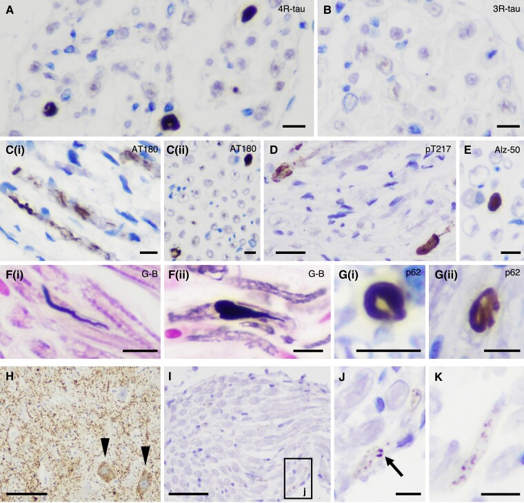 Staining profiles of PNS-tau in progressive supranuclear palsy (PSP) and comparing morphological features of tau-positive inclusions in PSP and corticobasal degeneration (CBD). (A–G) Representative photomicrographs of staining profiles of the PNS-tau in PSP. The tau-positive inclusions in the PNS are detected with 4-repeat tau specific antibody (RD4) (A) but not with 3-repeat tau-specific antibody (RD3) (B). The tau-positive inclusions are also recognized with several phosphorylated tau antibodies [C(i and ii): AT180 and D: pThr217] other than AT8 and also Alz-50, which is for misfolded tau (E). The inclusions in PSP often show large structures with fibrillary morphology (A and E), which are stained with Gallyas–Braak silver staining (G-B) [F(i and ii)]. Some inclusions also show p62-immunoreactivity [G(i and ii)]. (H–K) Representative photomicrographs of tau pathology in the PNS and related nuclei in CBD Case 3, namely anterior horn (H), spinal anterior roots (I and J: high magnification image of black box ‘j’ in I) in the cervical cord and IX/X nerve (K). Although this CBD case shows massive tau pathology in the anterior horn of the cervical cord (H, arrowhead: pre-tangle-like inclusions), there were only a few fine granular tau deposits in the spinal anterior roots (I and J). (K) A small number of granular tau deposits is present in the IX/X nerve. (A) RD4, (B) RD3, (C) AT180, (D) pThr217, (E) Alz-50, (F) G-B, (G) p62 and (H–K) AT8. Scale bars in A–C(i and ii), E, F(i and ii), G(i and ii), J and K = 10 μm, D = 20 μm, H = 100 μm and I = 50 μm.